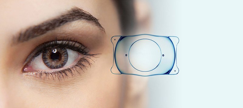 Benefits of ICL Lens Surgery: Why More People Are Choosing It