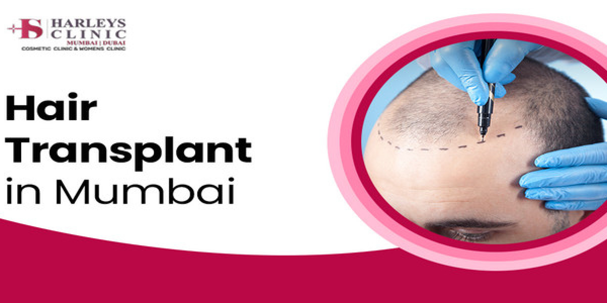Step-by-Step Guide to FUE Hair Transplant
